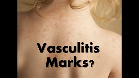 how to treat vasculitis